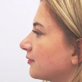 /media/upload/articles/rhinoplastikapo.jpeg