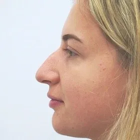 /media/upload/articles/rhinoplastikapred.jpeg